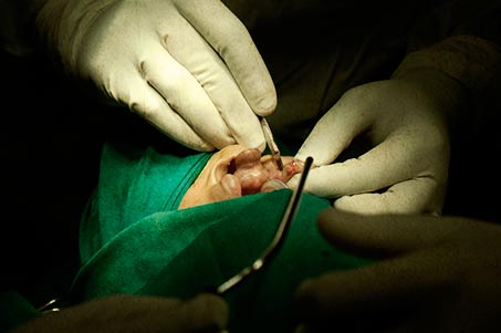 Durch einen operativen Eingriff kann die Spalte geschlossen werden. Es bleibt lediglich eine kleine Narbe zurück und für das Kind beginnt ein neues Leben.