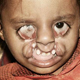 Sie wurde mit einer schweren doppelseitigen Spalte geboren, die über die Wangen bis an die Augen reichte. Dadurch ist ein Auge bereits erblindet.