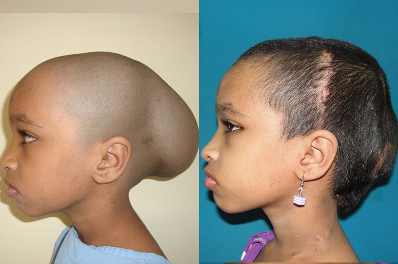 Tasreen (linke Seite) vor und nach der Operation