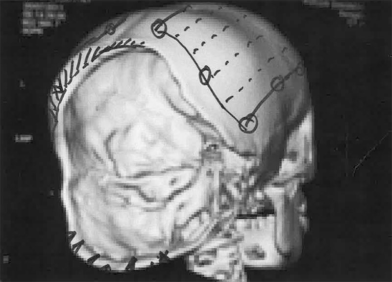 Röntgenaufnahme Schädel hinten mit Markierung von Prof. Sailer für die OP-Planung