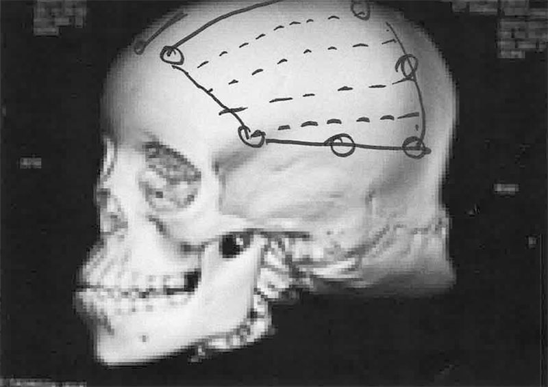 Röntgenaufnahme Schädel links mit Markierung von Prof. Sailer für die OP-Planung